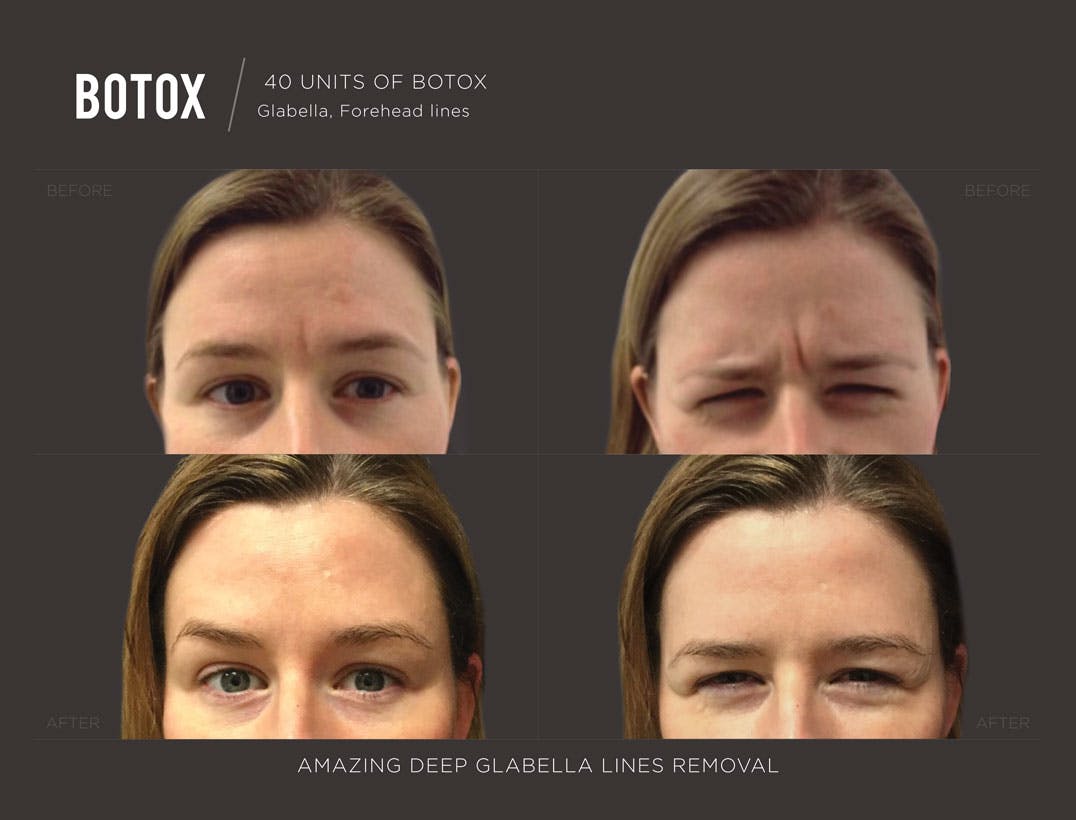 botox-new-york-results-trifectamedspa.jpg