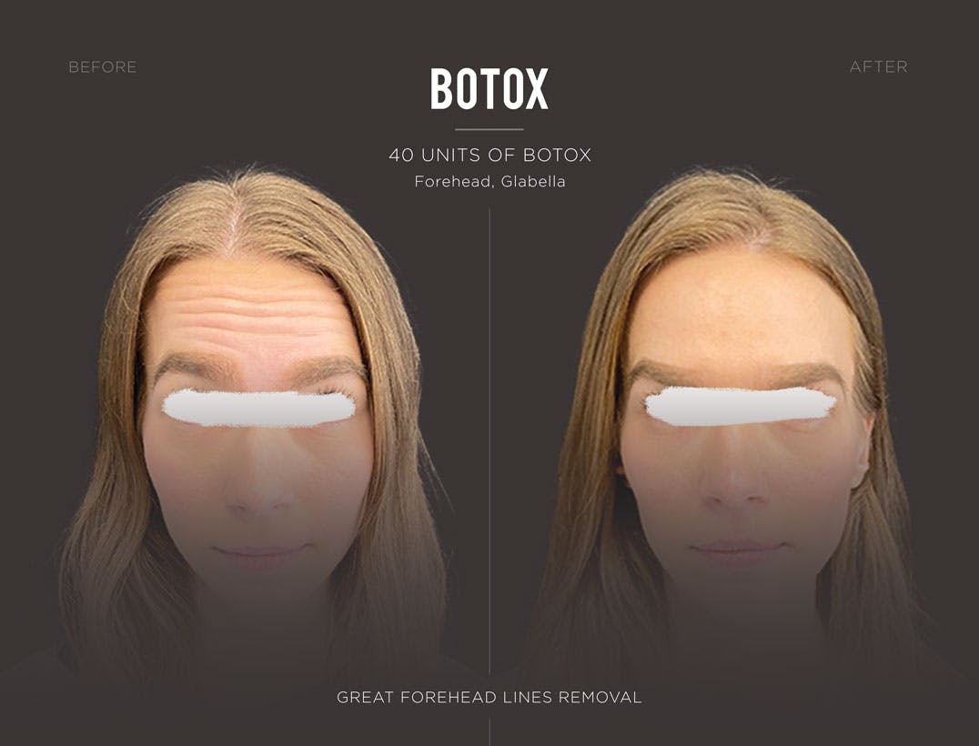 botox-nyc-woman-results-trifecta-med-spa.jpg
