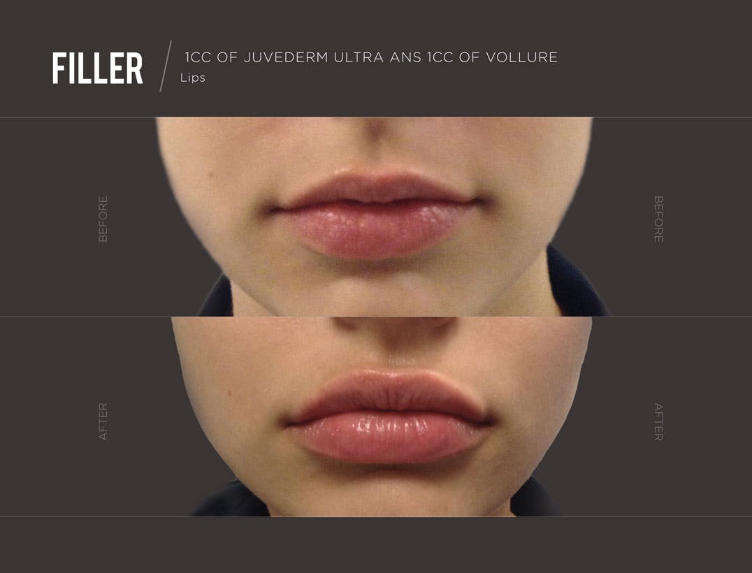 lip-filler-before-after-results-trifectamedspa-newyork-1.jpg