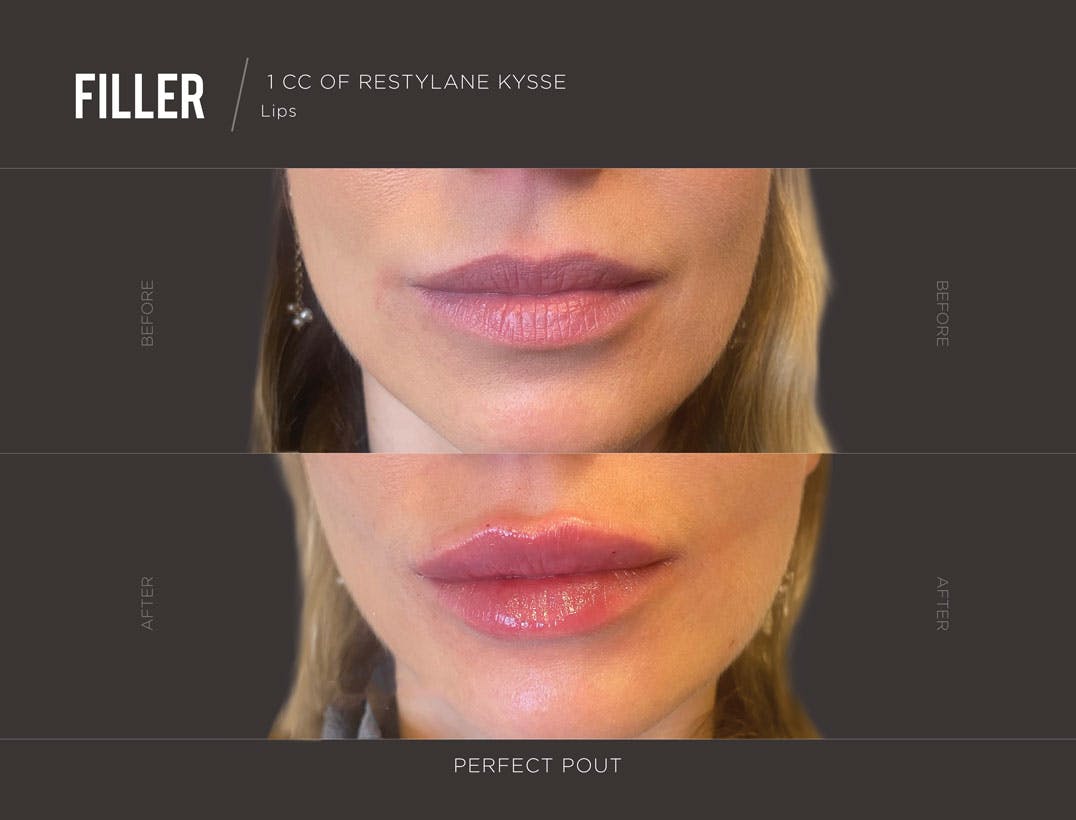 lip-filler-trifectamedspa-results-1-1.jpg