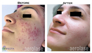 acne-before-after-300x173-300x173-1.png