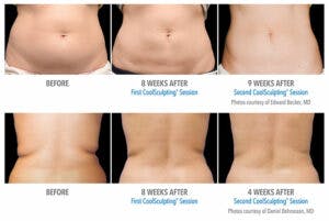 coolsculpting-before-after-300x201.jpg