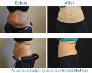coolsculpting-before-after-nyc-300x239.jpg