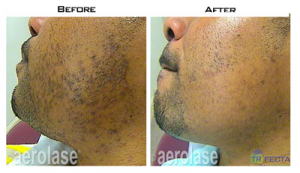 ingrown-hair-before-after-300x173-300x173-1.png